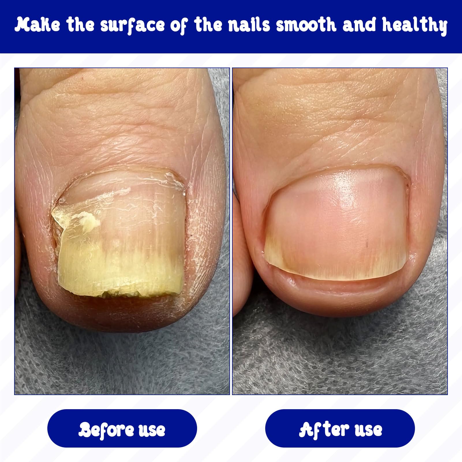 Fungal Nail Treatment,21PCS Toe Nail Fungal Treatment Patch